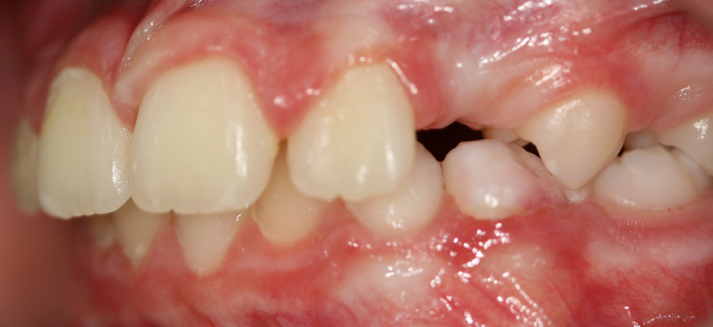 Ortopedia dentofacial después caso 11
